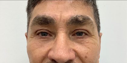 Upper Blepharoplasty Before & After Patient #3394