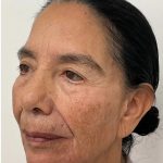 Full Face Enhancement (Botox + Filler Treatment) Before & After Patient #3377