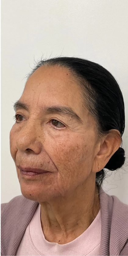 Full Face Enhancement (Botox + Filler Treatment) Before & After Patient #3377