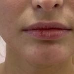 Lip Fillers Before & After Patient #3388