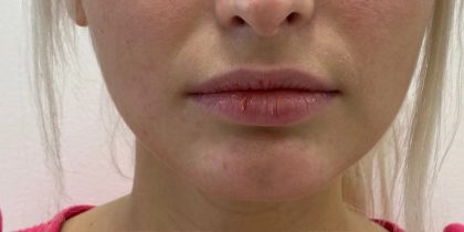 Lip Fillers Before & After Patient #3388