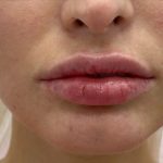 Lip Fillers Before & After Patient #3388