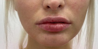 Lip Fillers Before & After Patient #3388