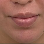 Lip Fillers Before & After Patient #3383