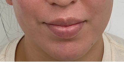 Lip Fillers Before & After Patient #3383