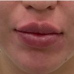 Lip Fillers Before & After Patient #3383