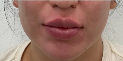 Lip Fillers Before & After Patient #3383