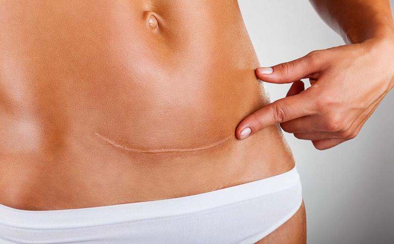 Scar & Stretch Mark Removal